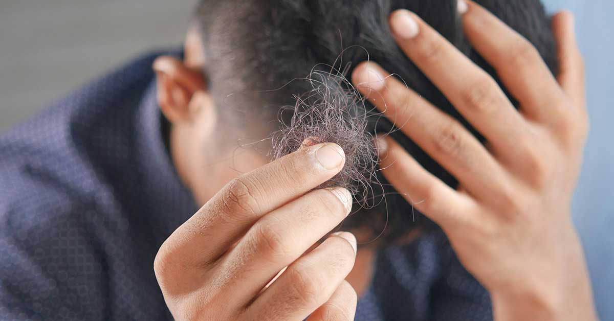 photo example of man experiencing hair loss